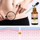 Acne Scar Removal Rejuvenation Serum | Scar, C section & Stretch Mark Removal Oil for women