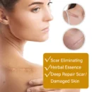 Acne Scar Removal Rejuvenation Serum | Scar, C section & Stretch Mark Removal Oil for women