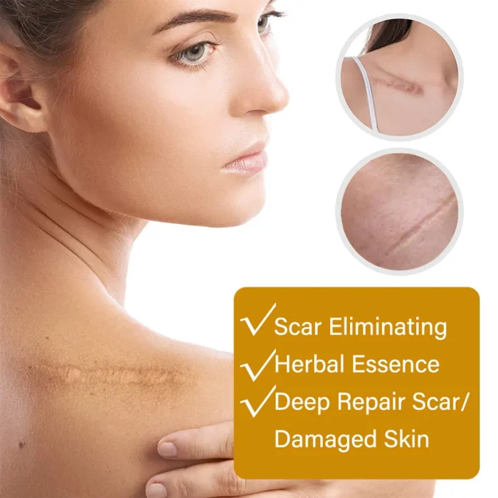 Acne Scar Removal Rejuvenation Serum | Scar, C section & Stretch Mark Removal Oil for women - Image 10